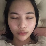 上海百达丽倪锋自体脂肪丰额头怎么样？案例分享