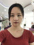 广州美莱罗延平肋软骨隆鼻怎么样？价格案例分享