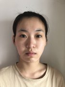 广州联合丽格郭震宇自体脂肪全脸填充怎么样？价格案例分享