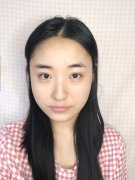 杭州丽脂曹飞超光纤溶脂瘦脸怎么样？价格案例分享