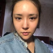 杭州华山连天美刘军膨体隆鼻怎么样？价格案例分享