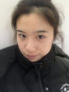 杭州薇琳徐少骏硅胶隆鼻怎么样？价格案例分享