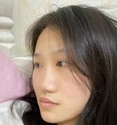 杭州薇琳徐少骏耳软骨隆鼻怎么样？价格案例分享