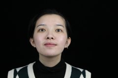 杭州珈禾徐丹自体脂肪全脸填充怎么样？价格案例分享