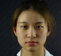昆明卓星井建切开双眼皮怎么样？价格案例分享