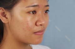 昆明梦想张燕雄肋软骨隆鼻怎么样？价格案例分享